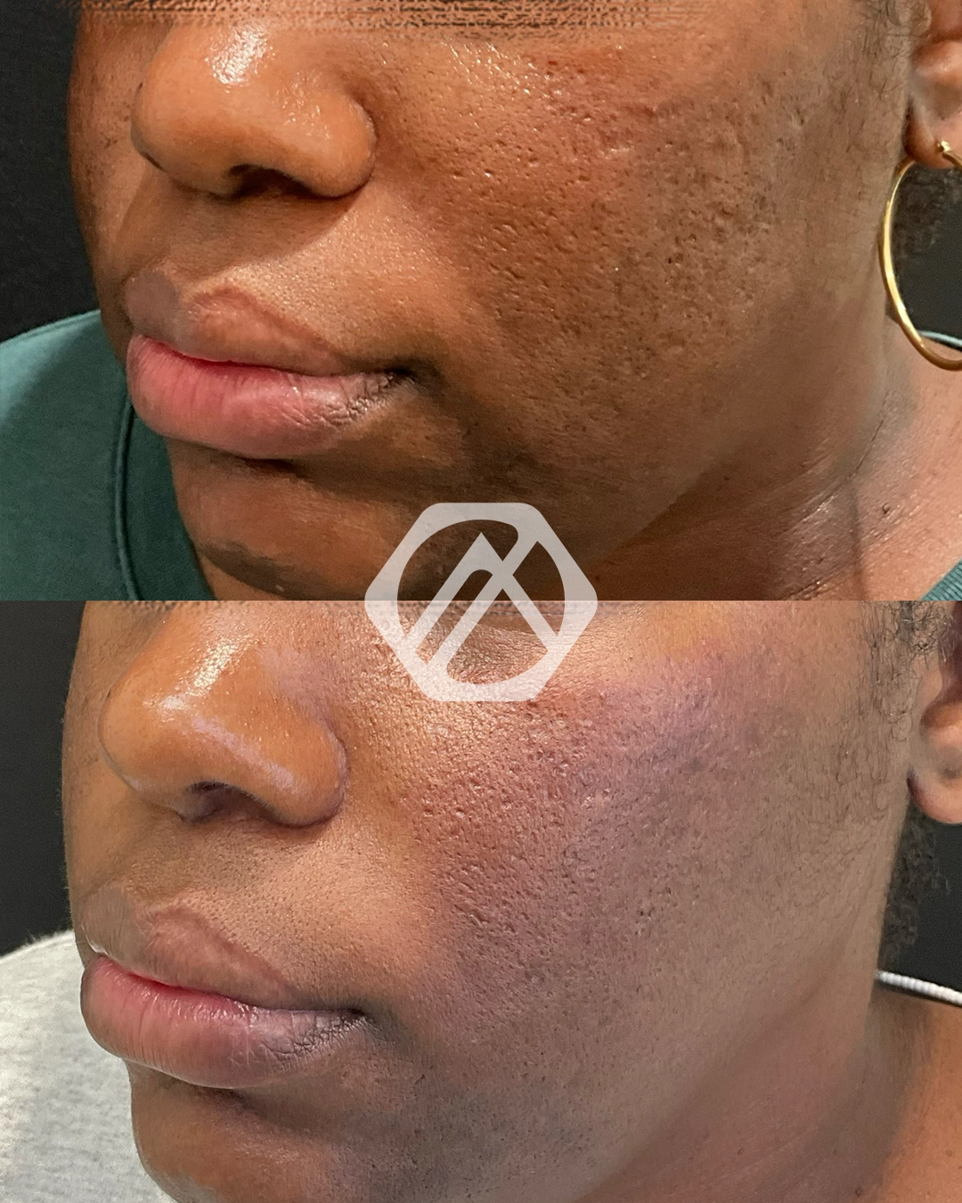 Acne Scar Treatment
