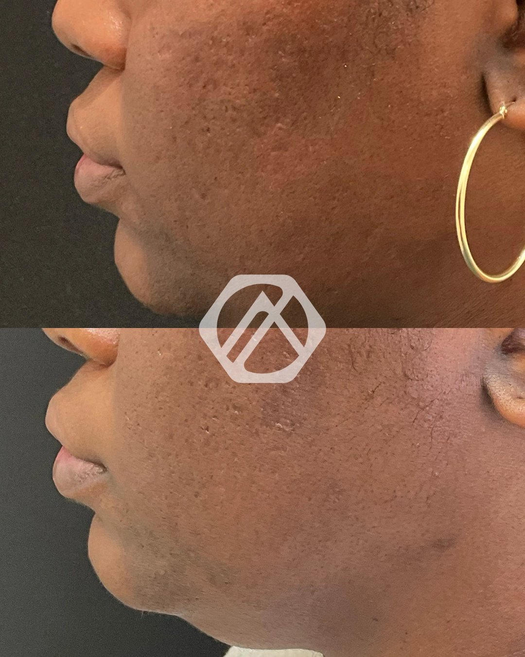 Acne Scar Treatment