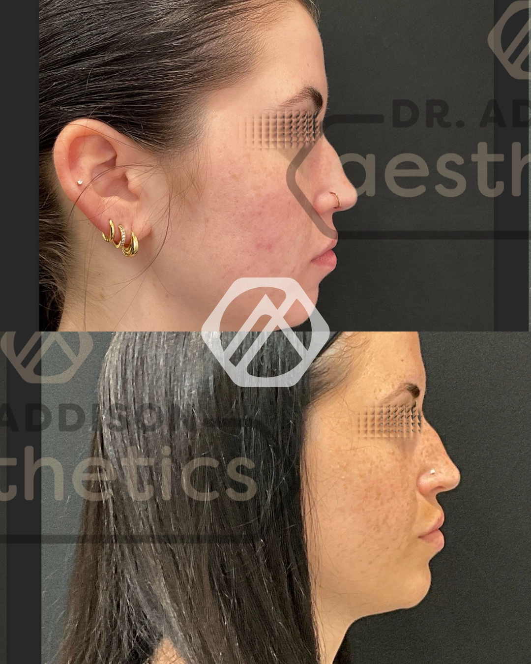 chin filler