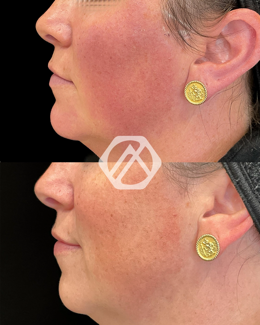 chin filler