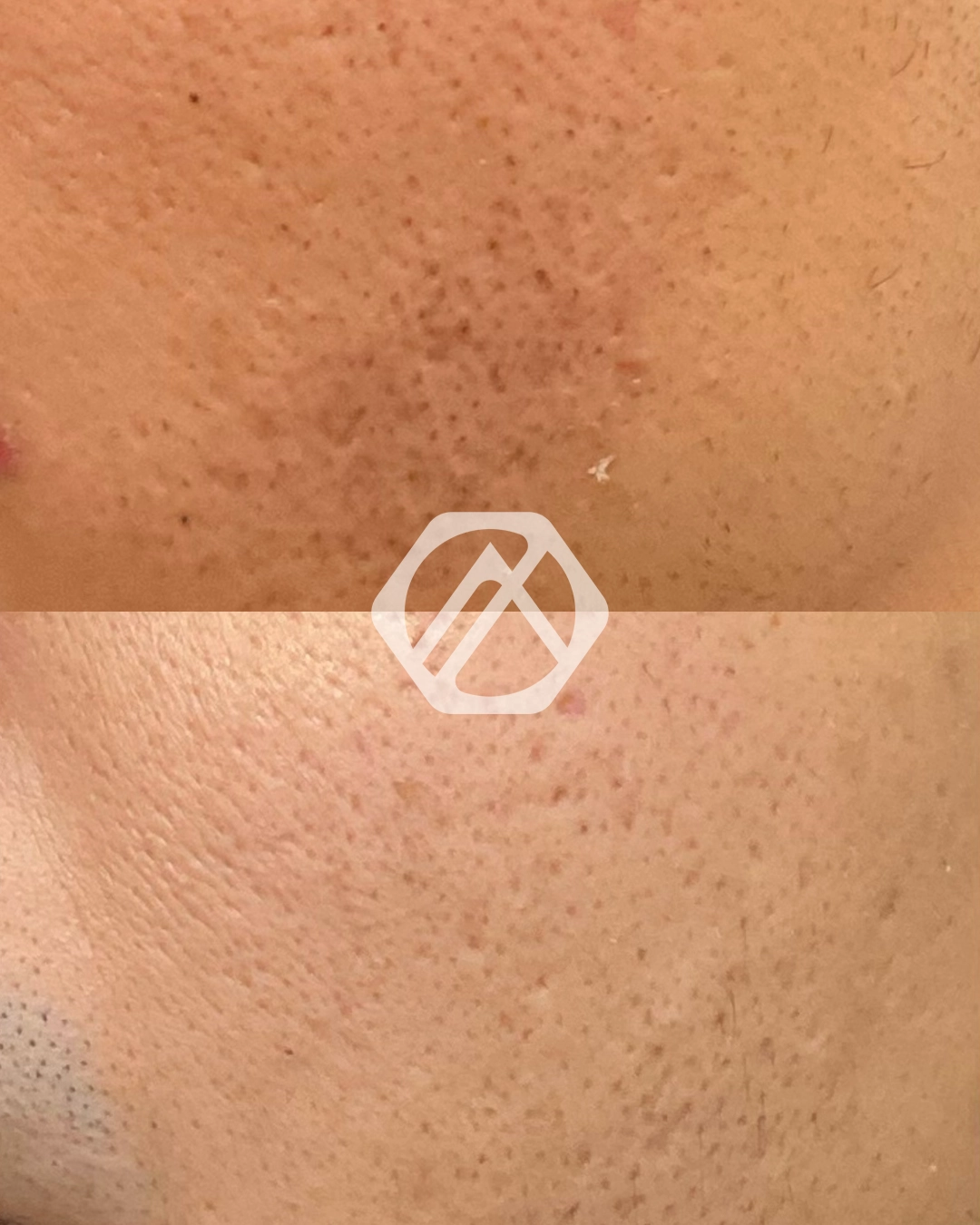 Hyperpigmentation