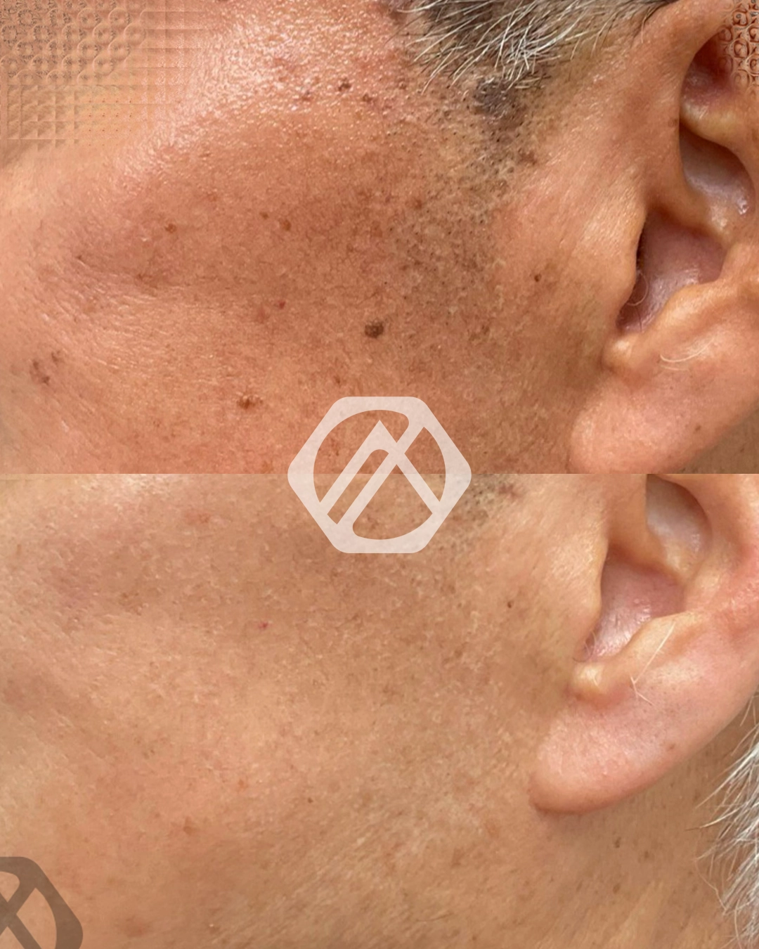Hyperpigmentation