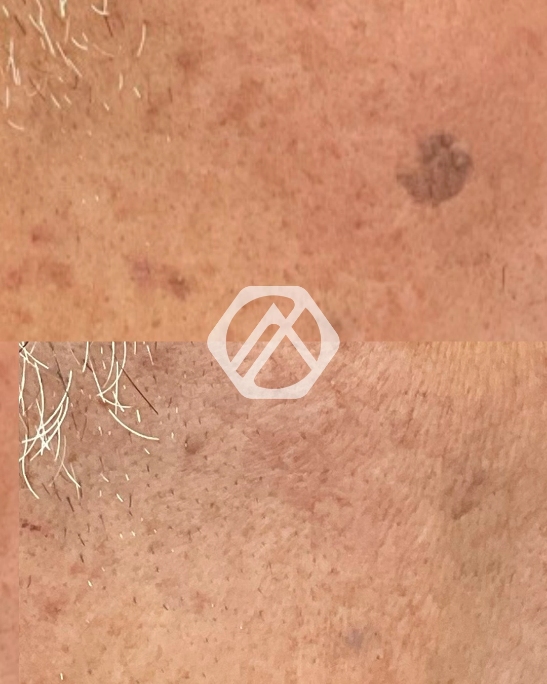 Hyperpigmentation
