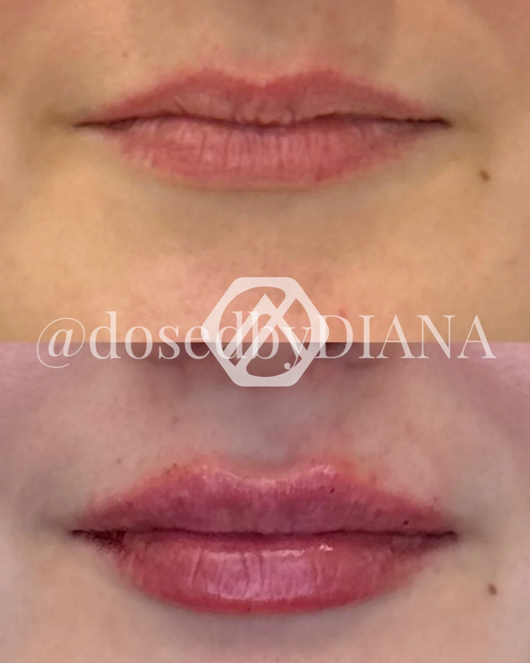 Lip filler
