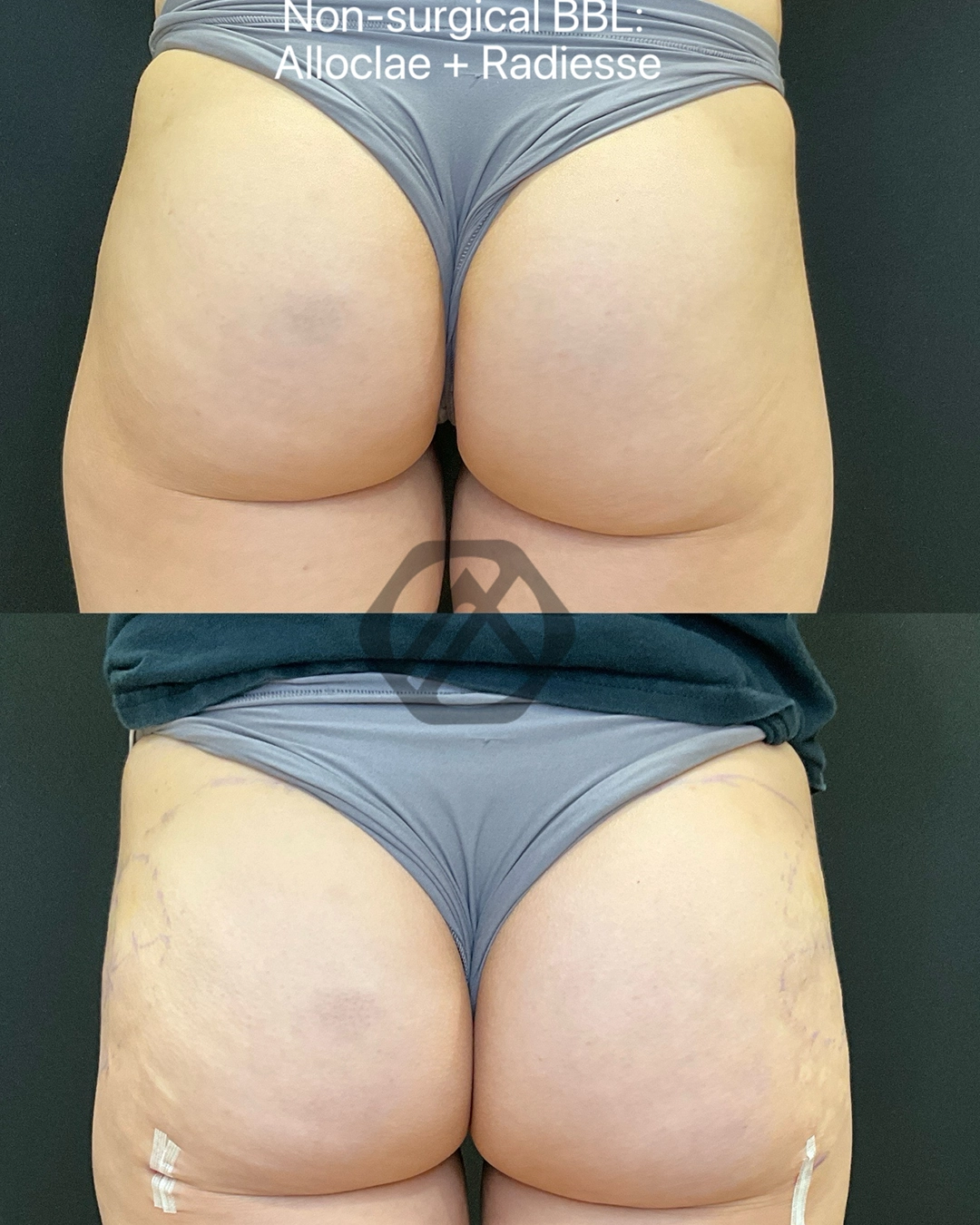 non-surgical BBL