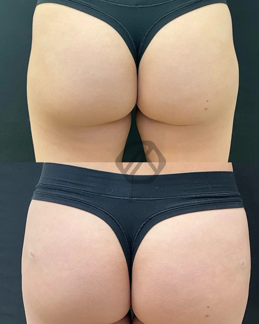 non-surgical BBL
