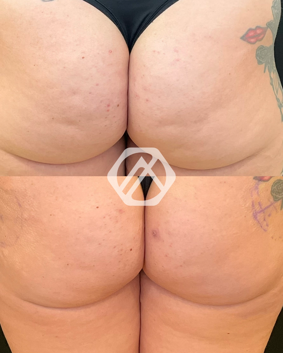 non-surgical BBL