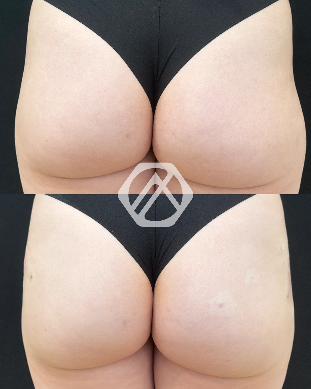 non-surgical BBL