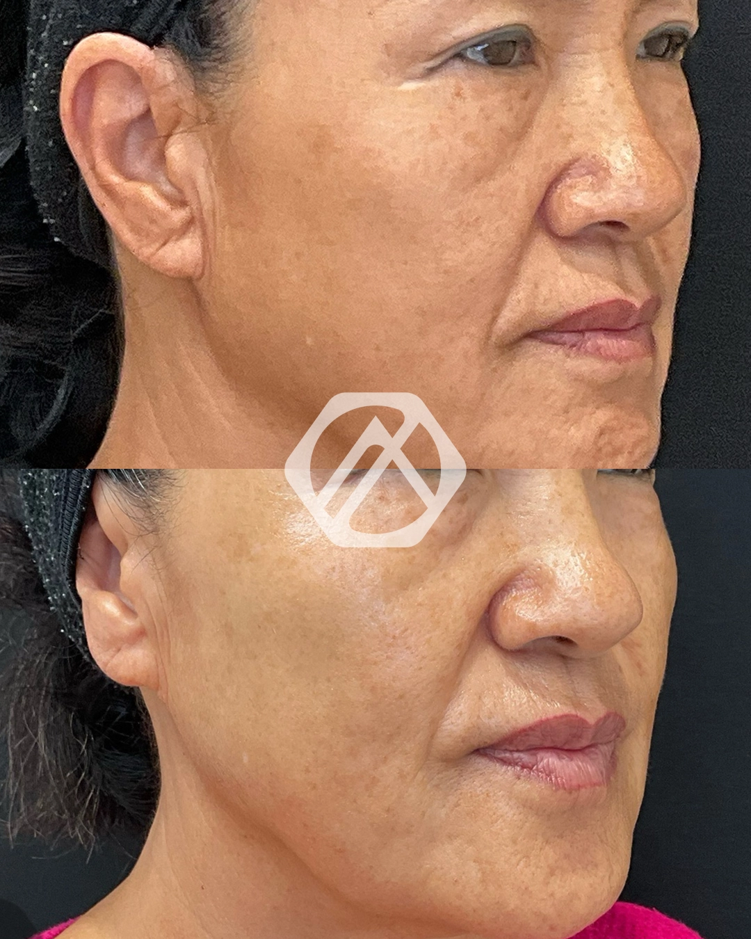 Skin Tightening Lifting Devices