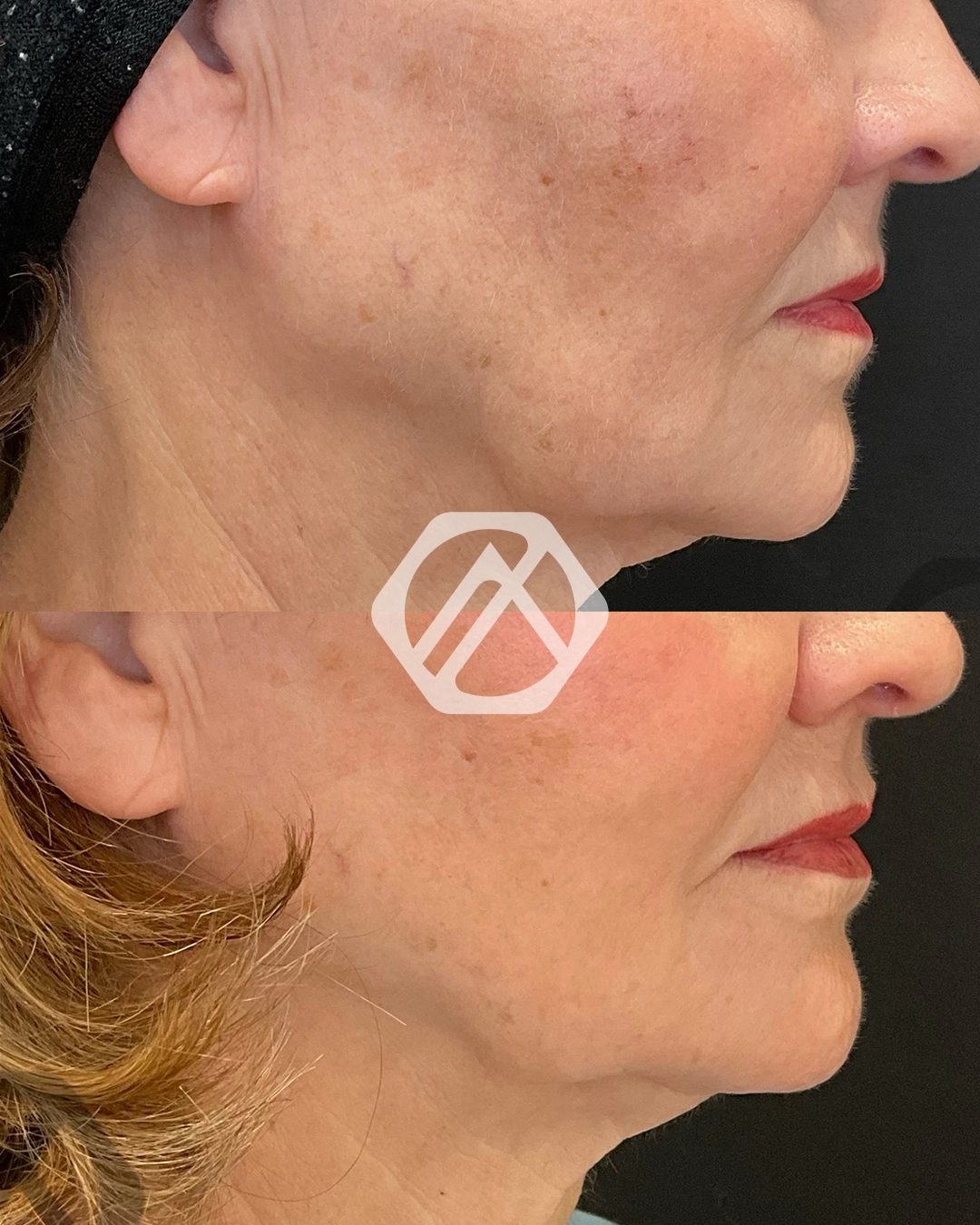 Skin Tightening Lifting Devices