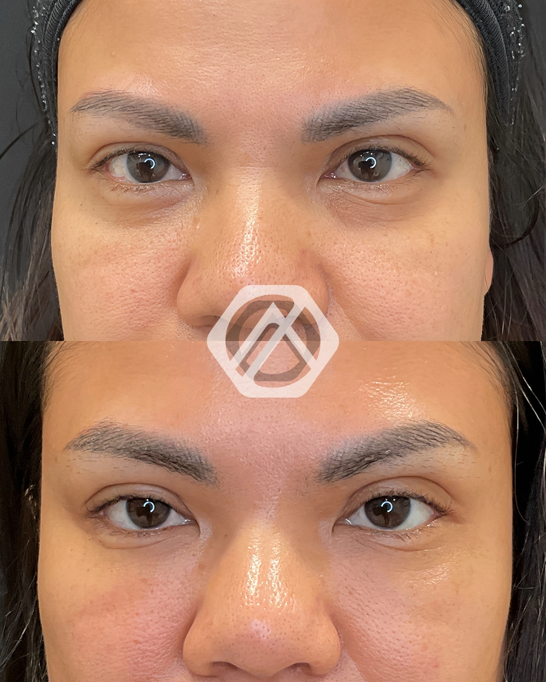 Undereye