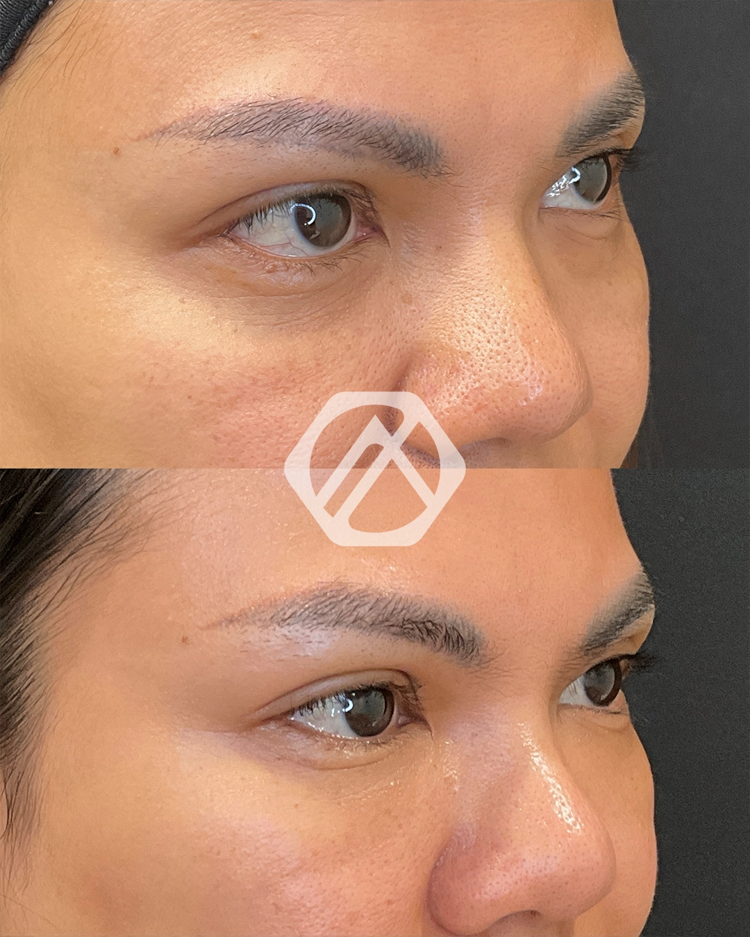 Undereye
